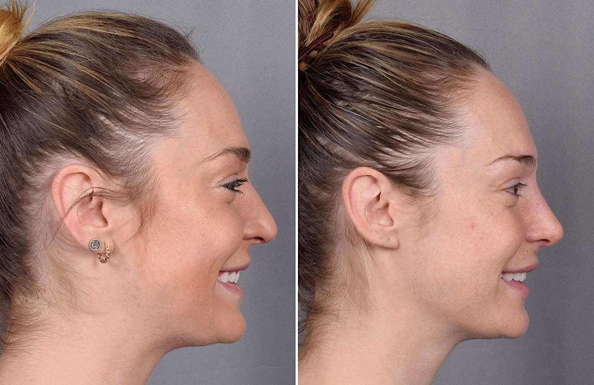 Rhinoplasty Before & After Gallery - Patient 276318 - Image 1