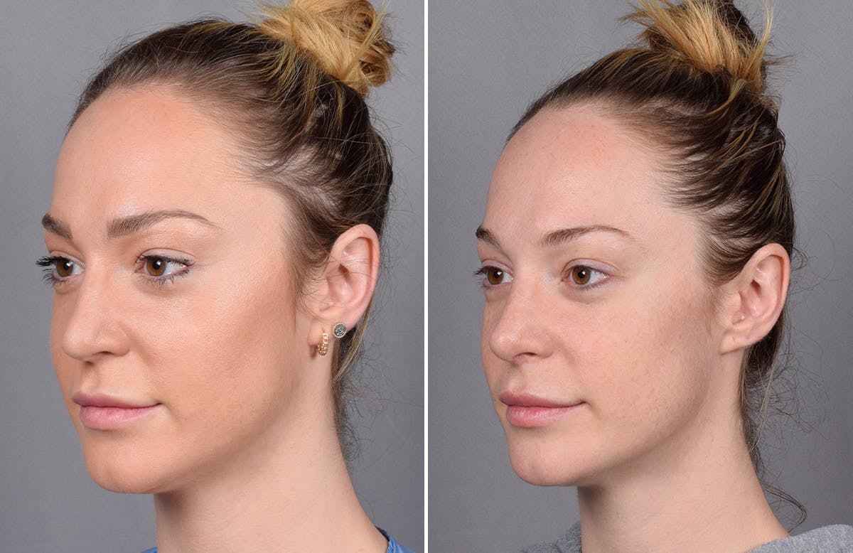 Rhinoplasty Before & After Gallery - Patient 276318 - Image 5