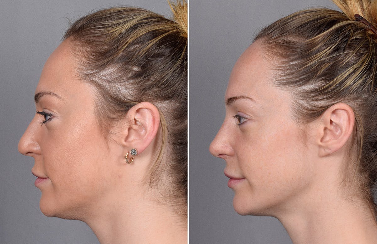 Rhinoplasty Before & After Gallery - Patient 276318 - Image 6