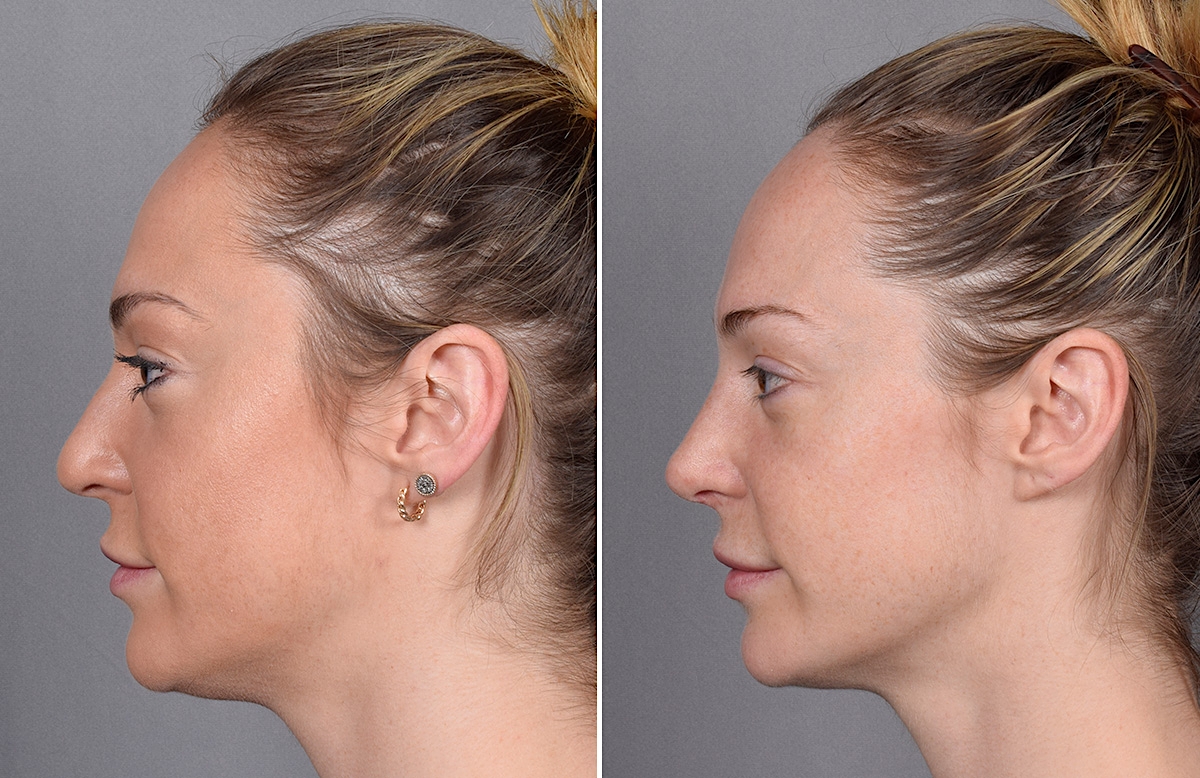 Rhinoplasty Before & After Gallery - Patient 276318 - Image 6