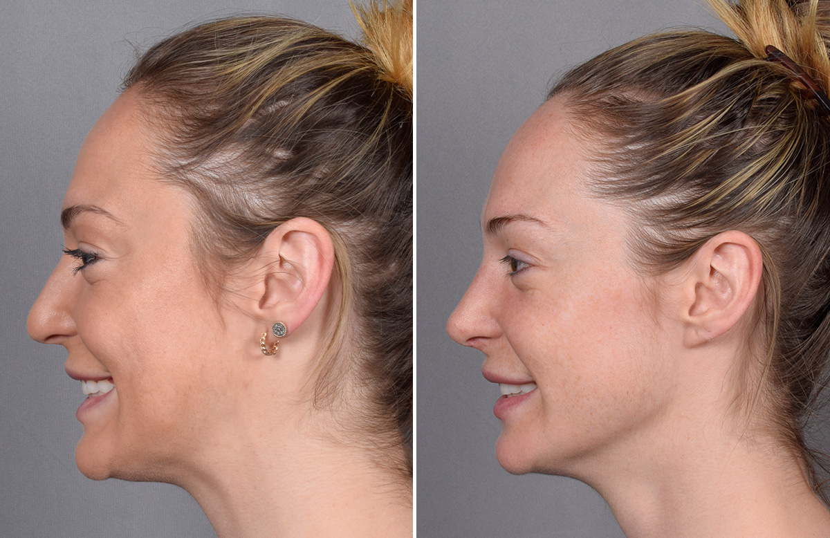 Rhinoplasty Before & After Gallery - Patient 276318 - Image 7