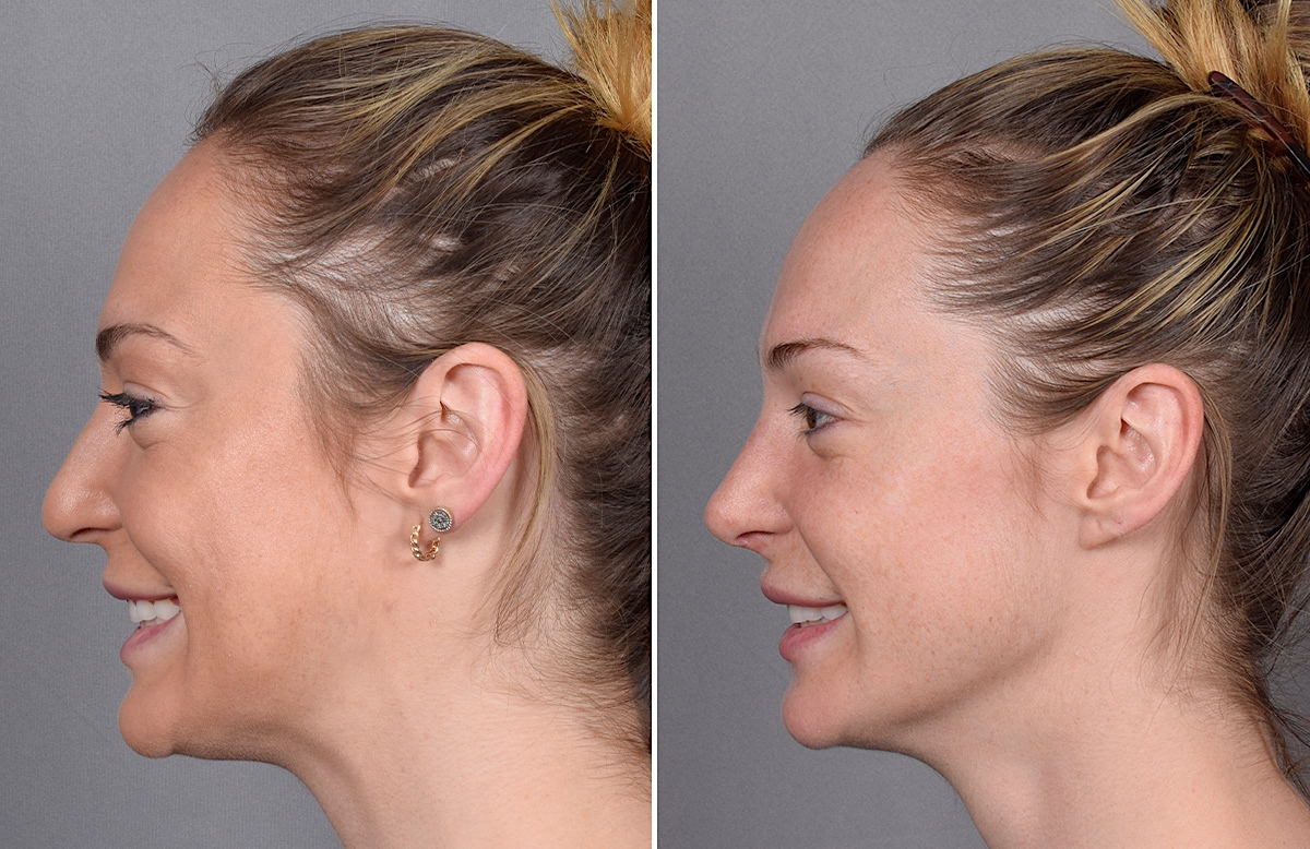 Rhinoplasty Before & After Gallery - Patient 276318 - Image 7