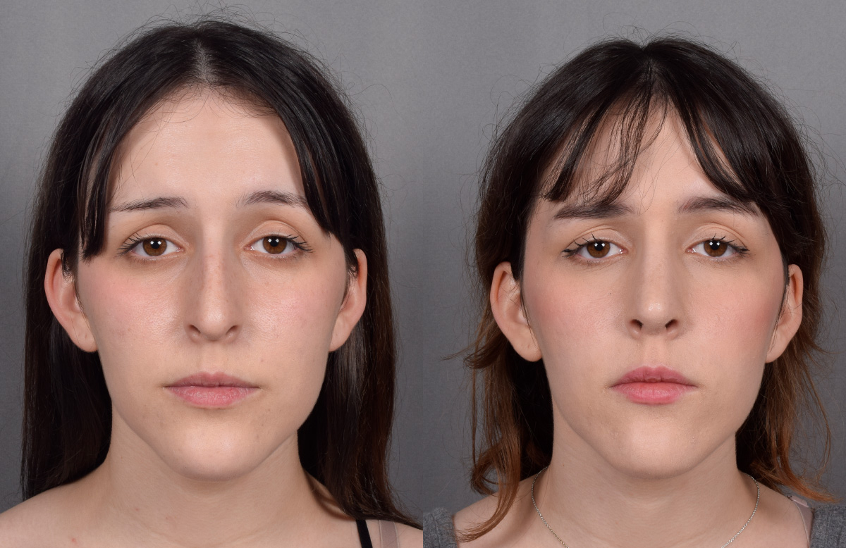 Rhinoplasty Before & After Gallery - Patient 885575 - Image 4