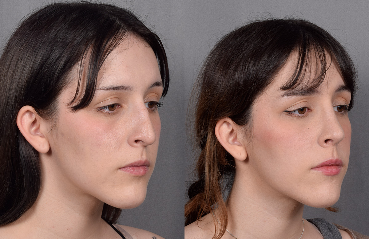Rhinoplasty Before & After Gallery - Patient 885575 - Image 3