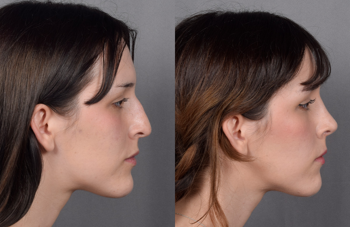 Rhinoplasty Before & After Gallery - Patient 885575 - Image 2