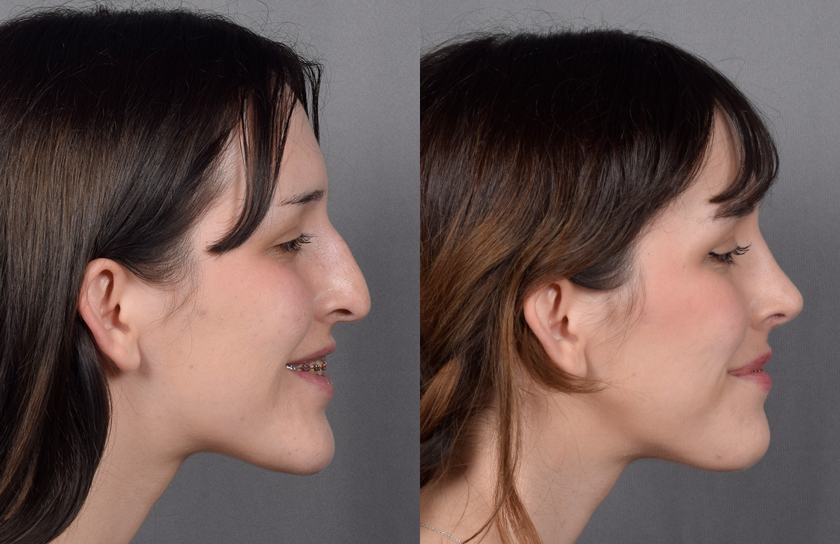 Rhinoplasty Before & After Gallery - Patient 885575 - Image 1