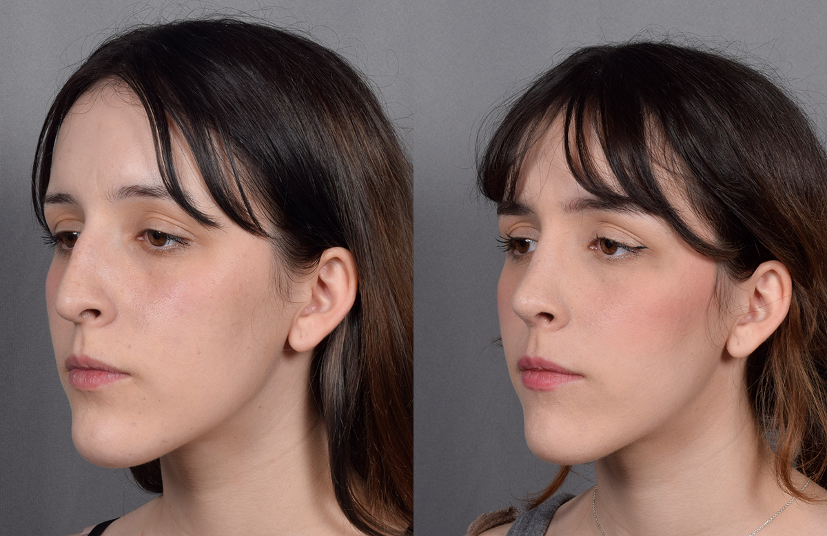 Rhinoplasty Before & After Gallery - Patient 885575 - Image 5