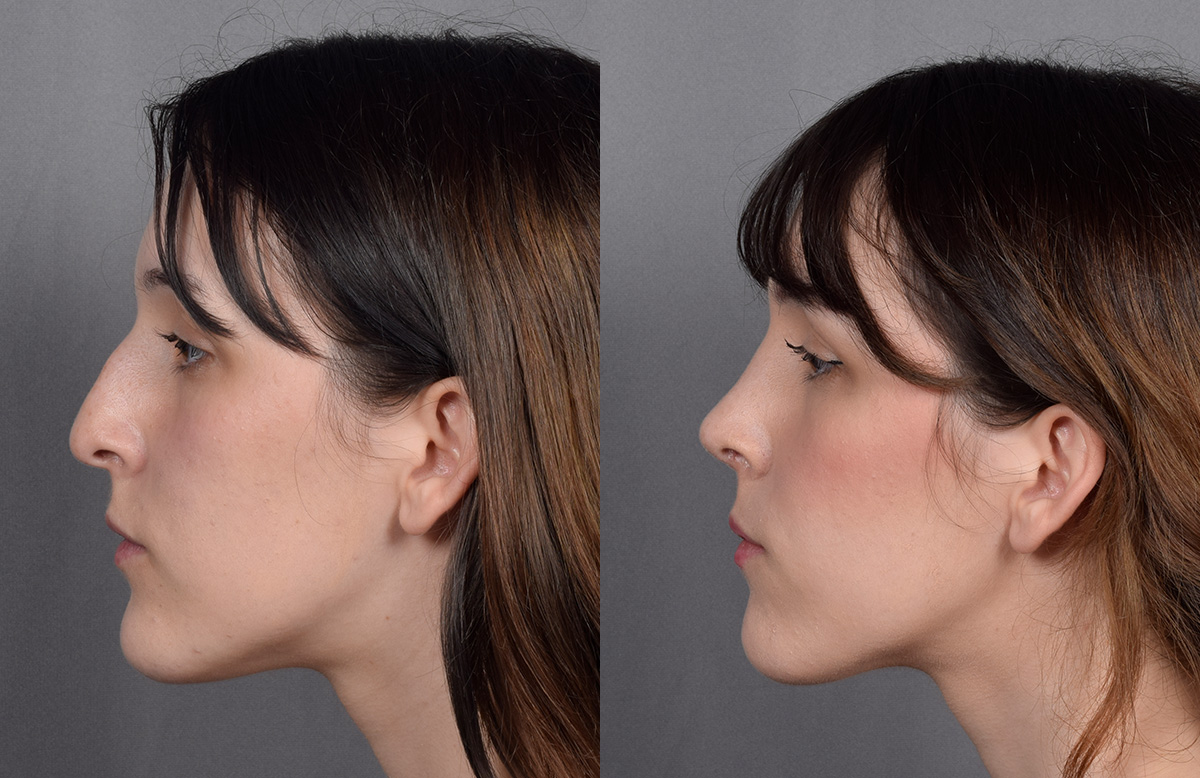 Rhinoplasty Before & After Gallery - Patient 885575 - Image 6