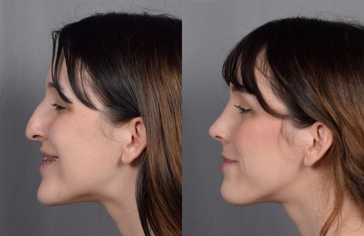 Rhinoplasty Before & After Gallery - Patient 885575 - Image 7