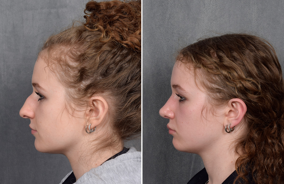 Rhinoplasty Before & After Gallery - Patient 102079 - Image 6