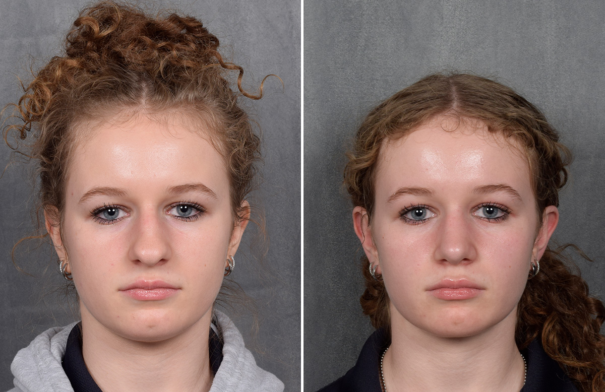 Rhinoplasty Before & After Gallery - Patient 102079 - Image 4