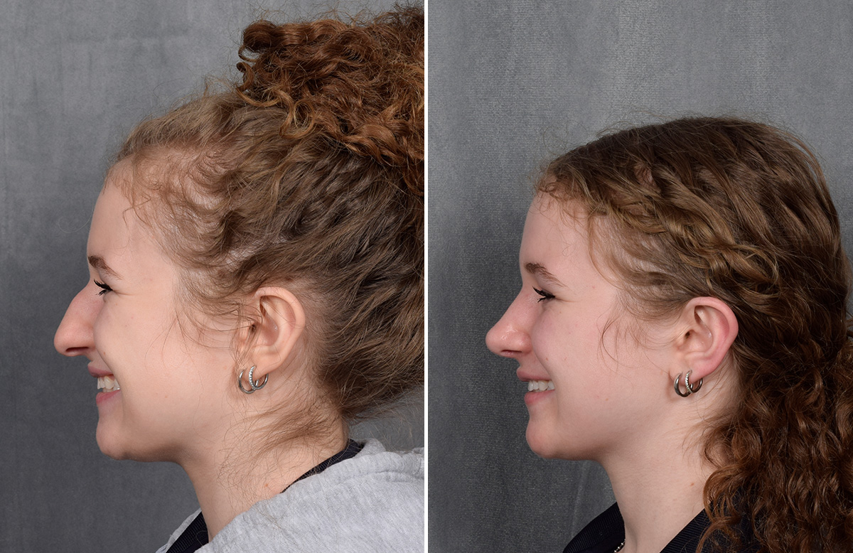 Rhinoplasty Before & After Gallery - Patient 102079 - Image 7