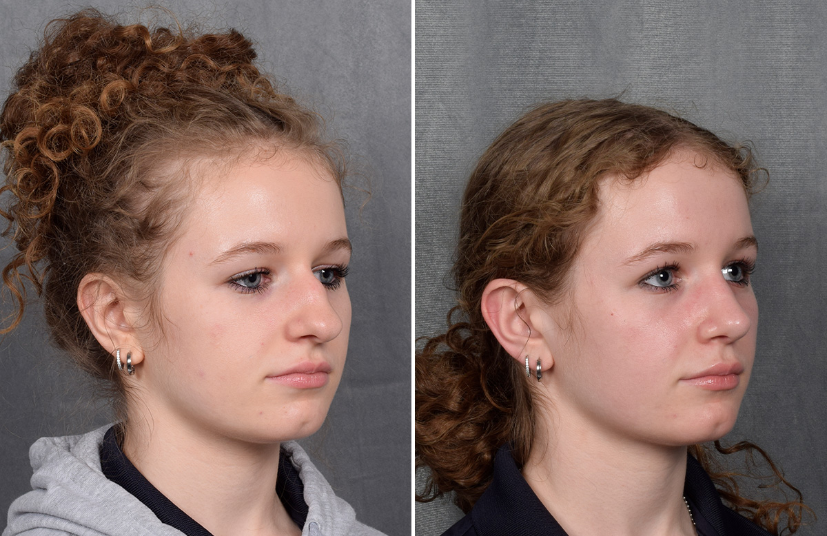 Rhinoplasty Before & After Gallery - Patient 102079 - Image 3