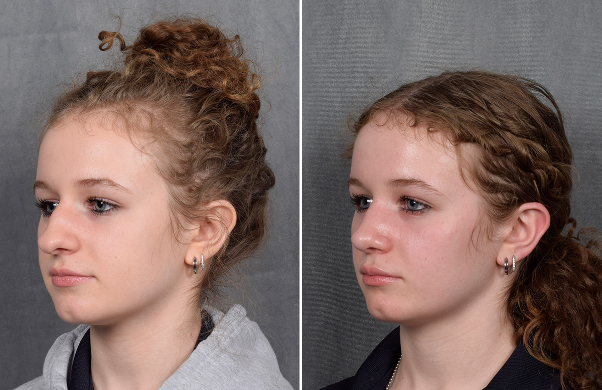 Rhinoplasty Before & After Gallery - Patient 102079 - Image 5