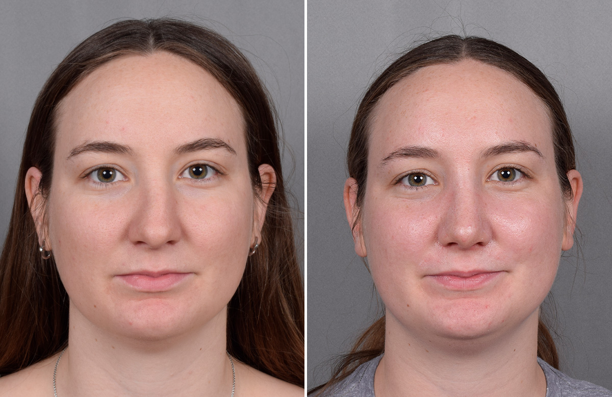 Rhinoplasty Before & After Gallery - Patient 130693 - Image 4