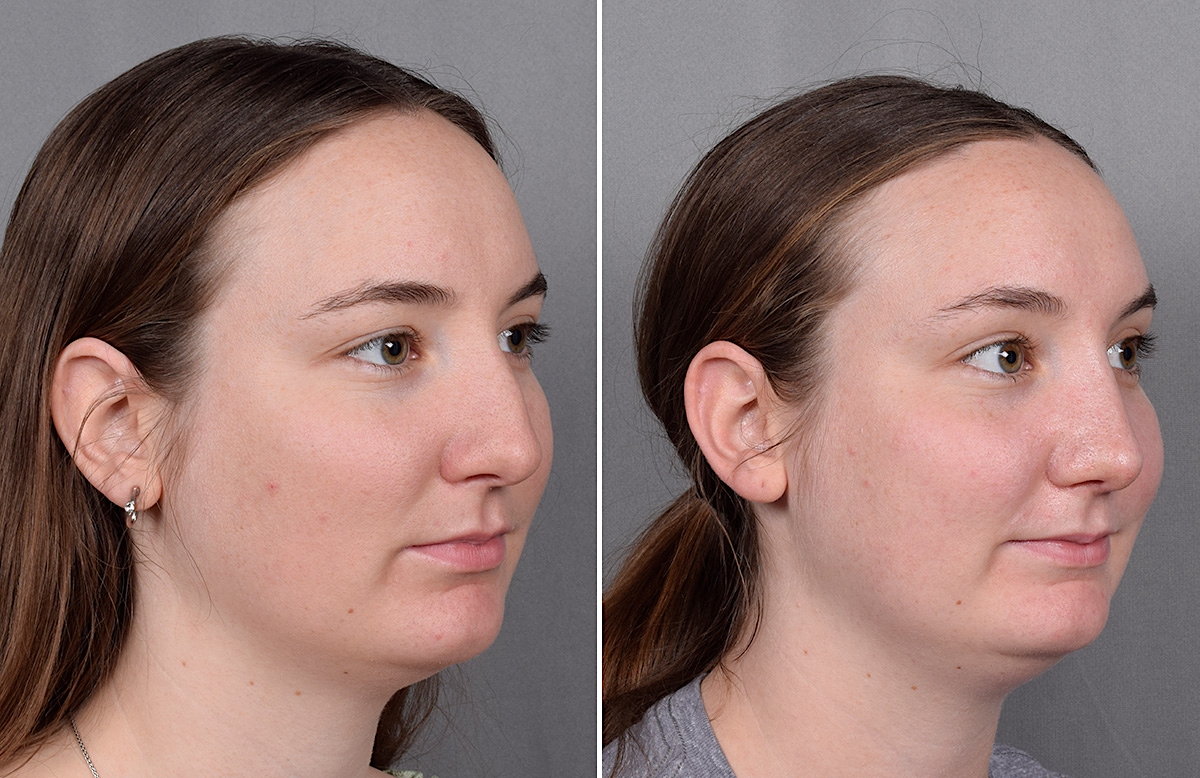 Rhinoplasty Before & After Gallery - Patient 130693 - Image 3
