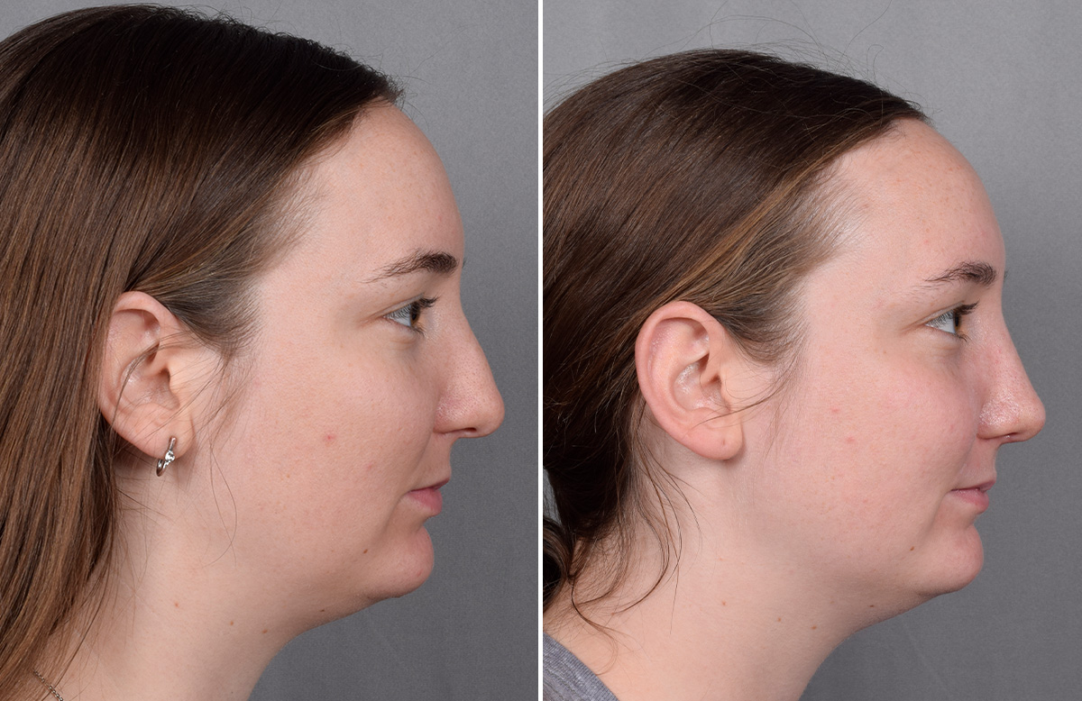 Rhinoplasty Before & After Gallery - Patient 130693 - Image 2