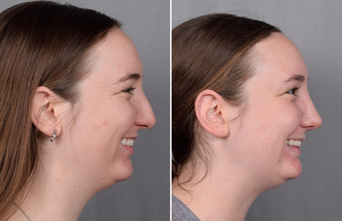 Rhinoplasty Before & After Gallery - Patient 130693 - Image 1