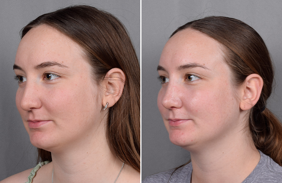 Rhinoplasty Before & After Gallery - Patient 130693 - Image 5