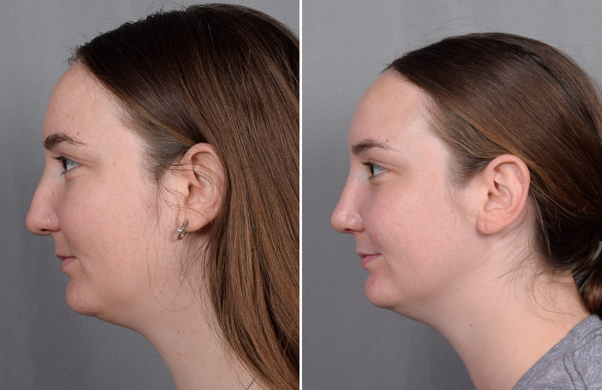Rhinoplasty Before & After Gallery - Patient 130693 - Image 6