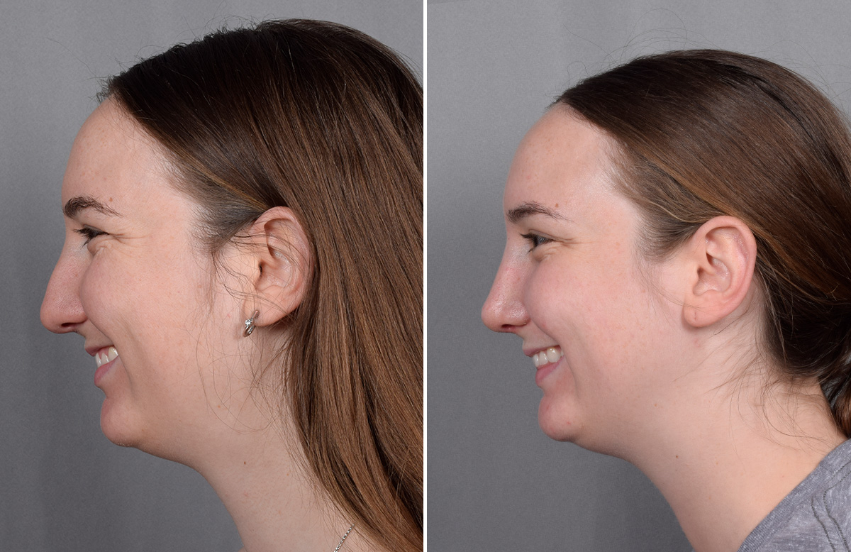 Rhinoplasty Before & After Gallery - Patient 130693 - Image 7
