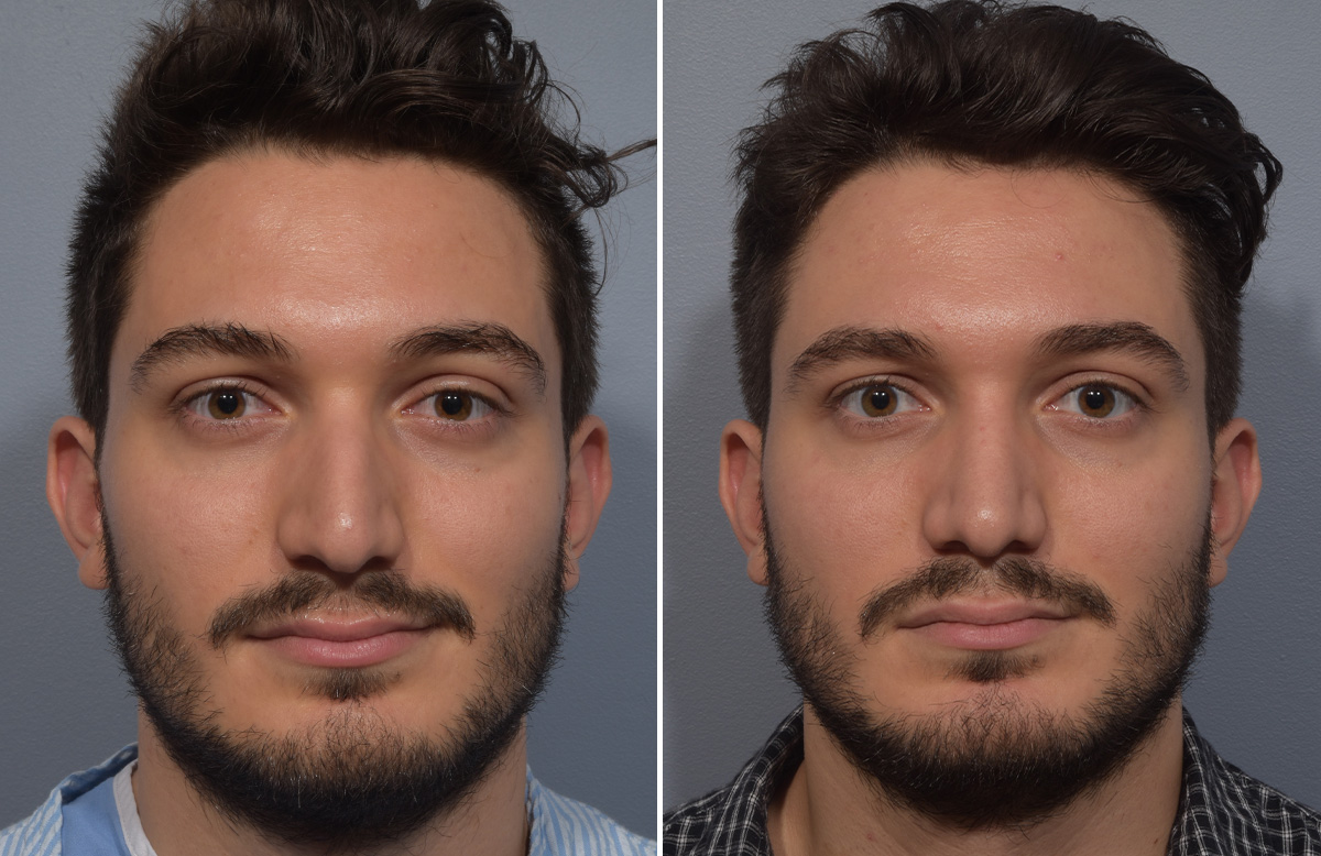 Rhinoplasty Before & After Gallery - Patient 389432 - Image 4