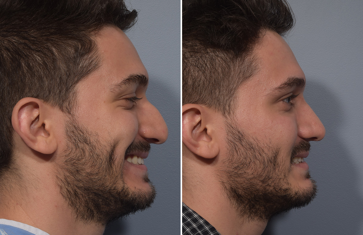 Rhinoplasty Before & After Gallery - Patient 389432 - Image 1