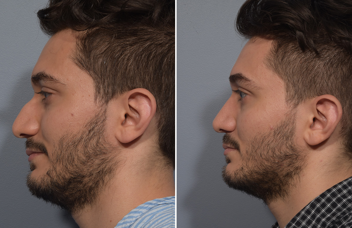 Rhinoplasty Before & After Gallery - Patient 389432 - Image 6