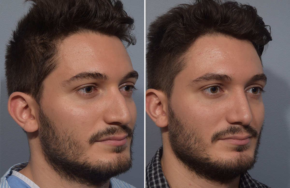 Rhinoplasty Before & After Gallery - Patient 389432 - Image 3