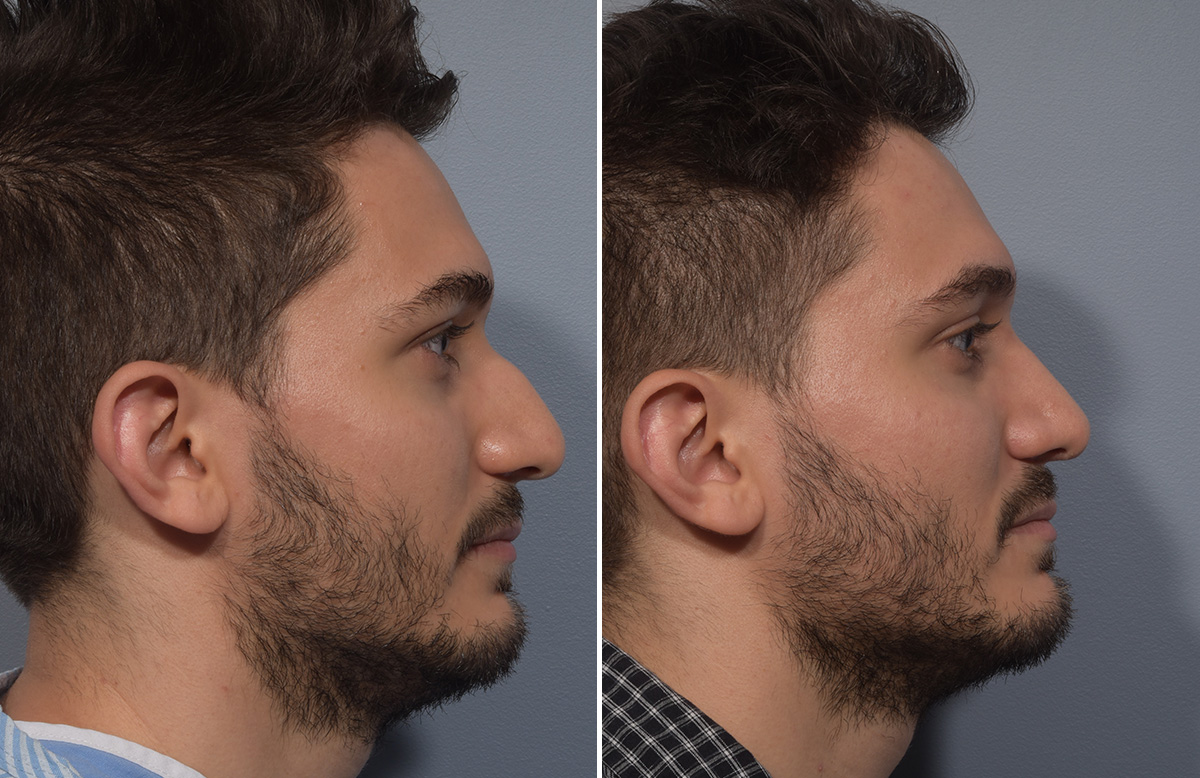 Rhinoplasty Before & After Gallery - Patient 389432 - Image 2