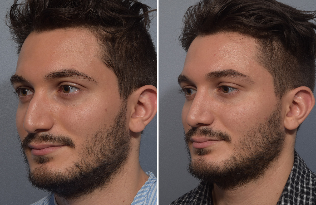 Rhinoplasty Before & After Gallery - Patient 389432 - Image 5