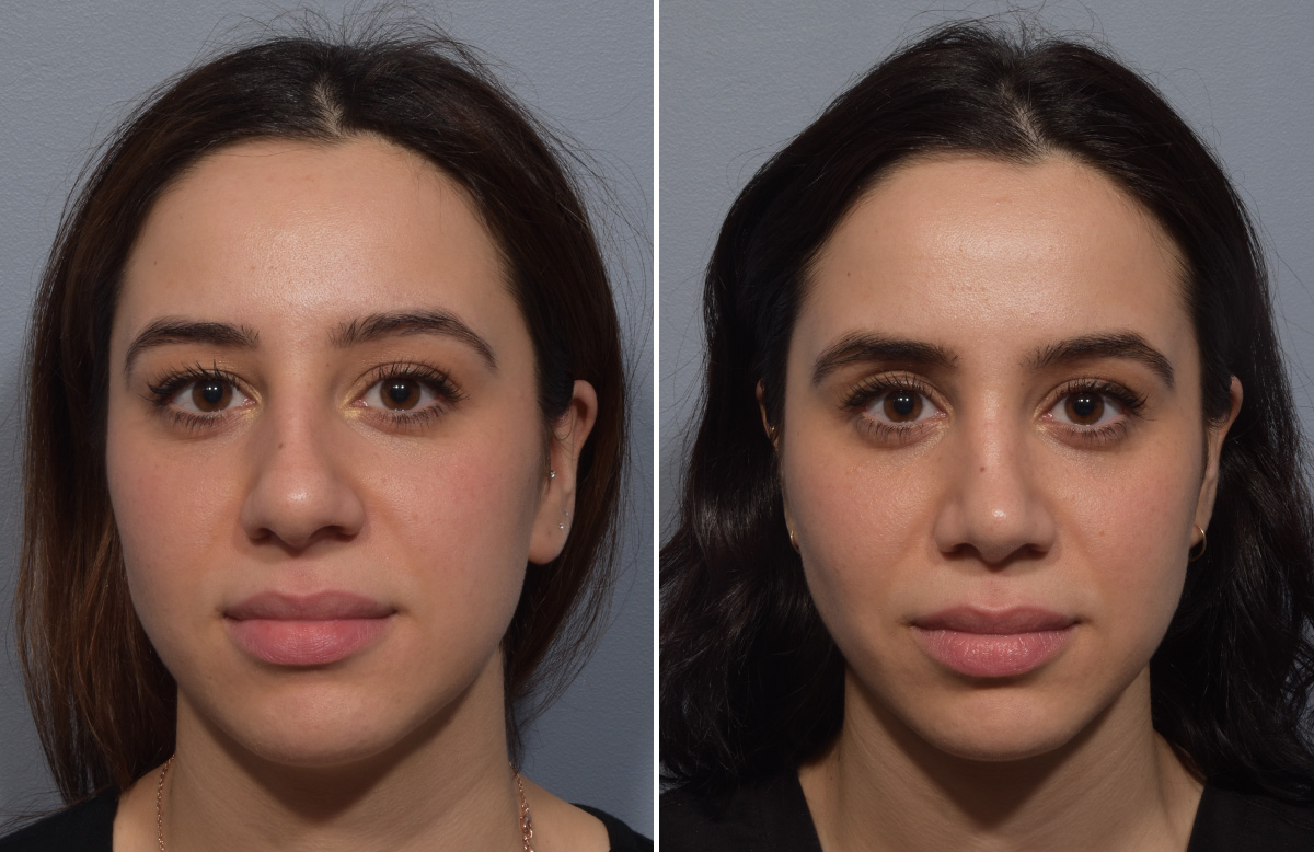 Rhinoplasty Before & After Gallery - Patient 904879 - Image 4