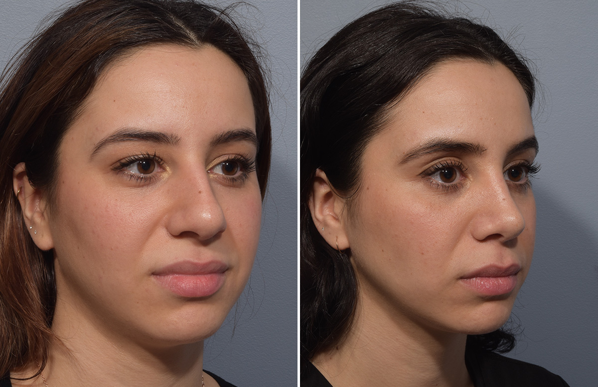 Rhinoplasty Before & After Gallery - Patient 904879 - Image 3