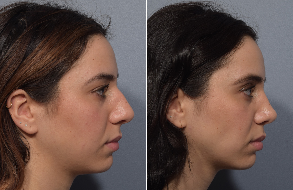 Rhinoplasty Before & After Gallery - Patient 904879 - Image 2