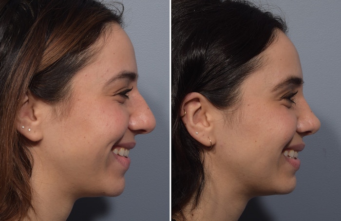 Rhinoplasty Before & After Gallery - Patient 904879 - Image 1