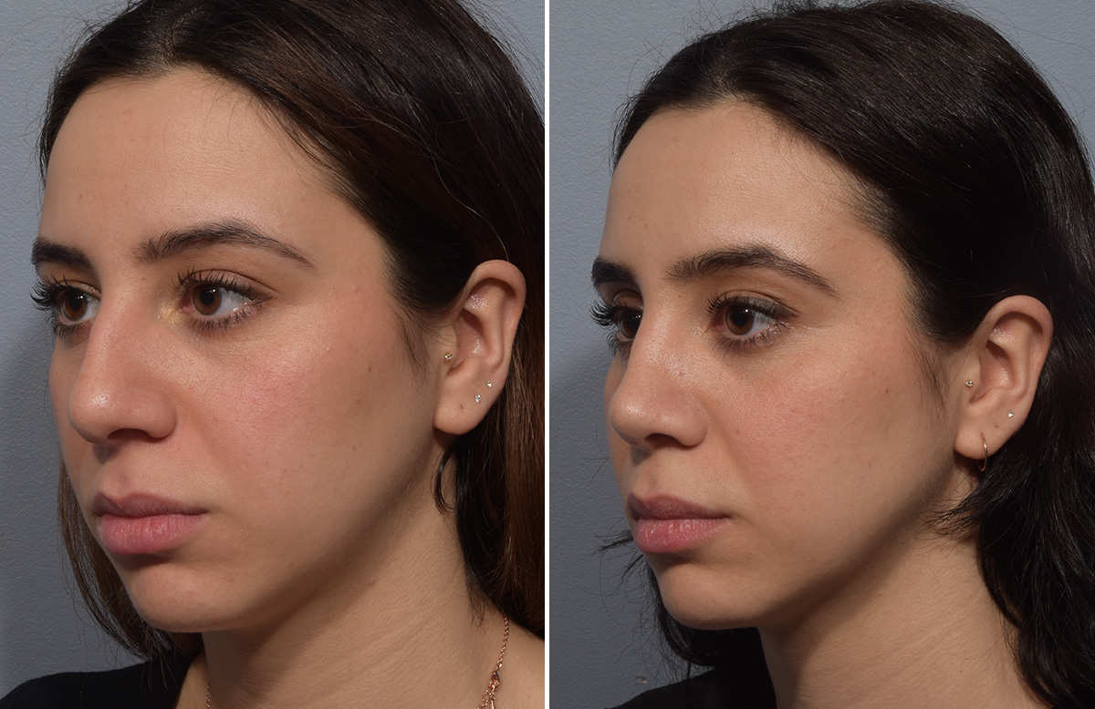 Rhinoplasty Before & After Gallery - Patient 904879 - Image 5