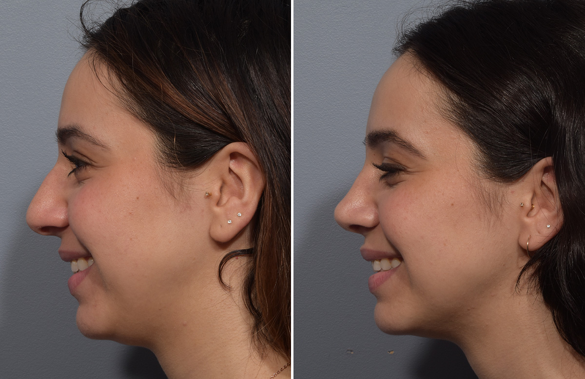 Rhinoplasty Before & After Gallery - Patient 904879 - Image 7