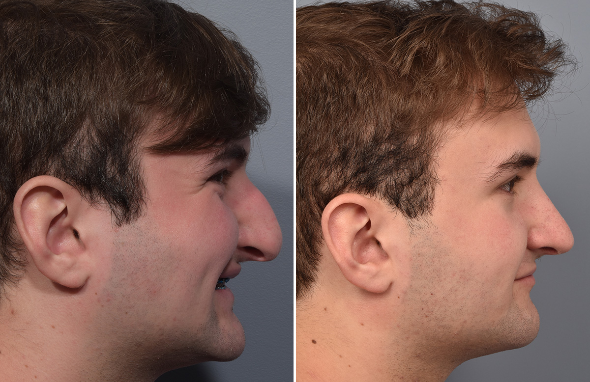 Rhinoplasty Before & After Gallery - Patient 124777 - Image 1