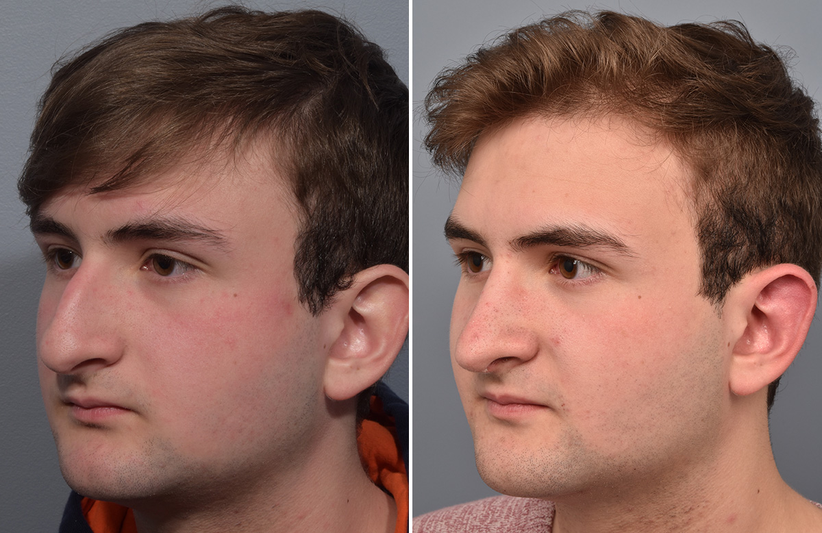 Rhinoplasty Before & After Gallery - Patient 124777 - Image 5