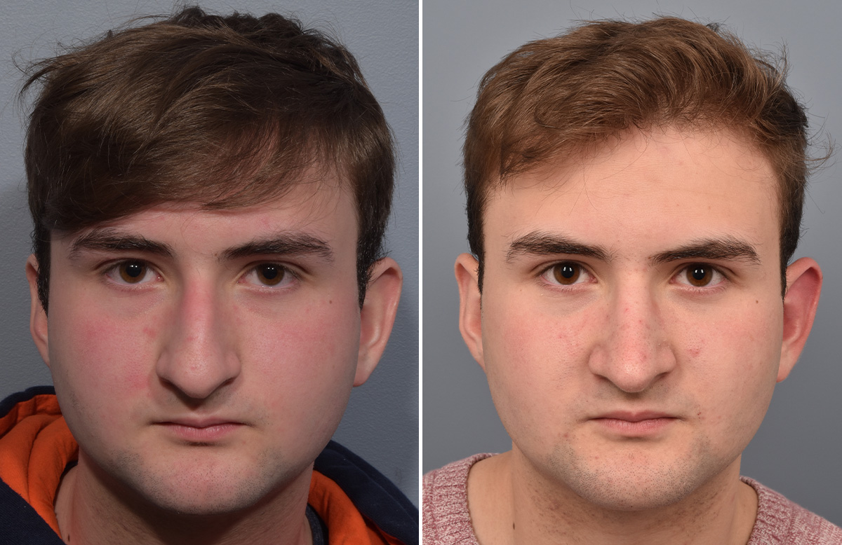 Rhinoplasty Before & After Gallery - Patient 124777 - Image 4