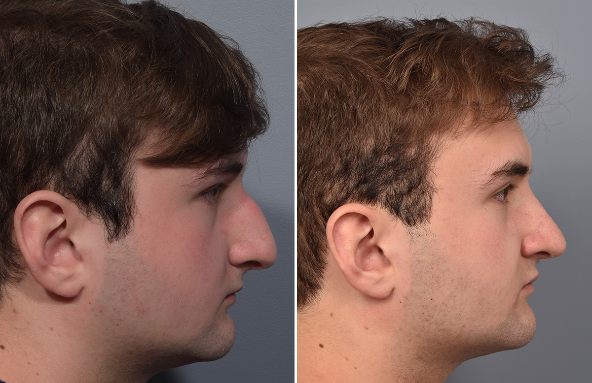 Rhinoplasty Before & After Gallery - Patient 124777 - Image 2