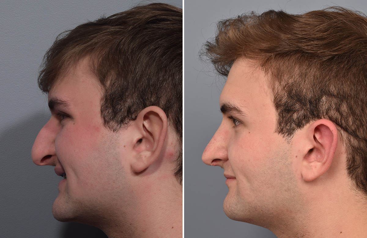 Rhinoplasty Before & After Gallery - Patient 124777 - Image 7