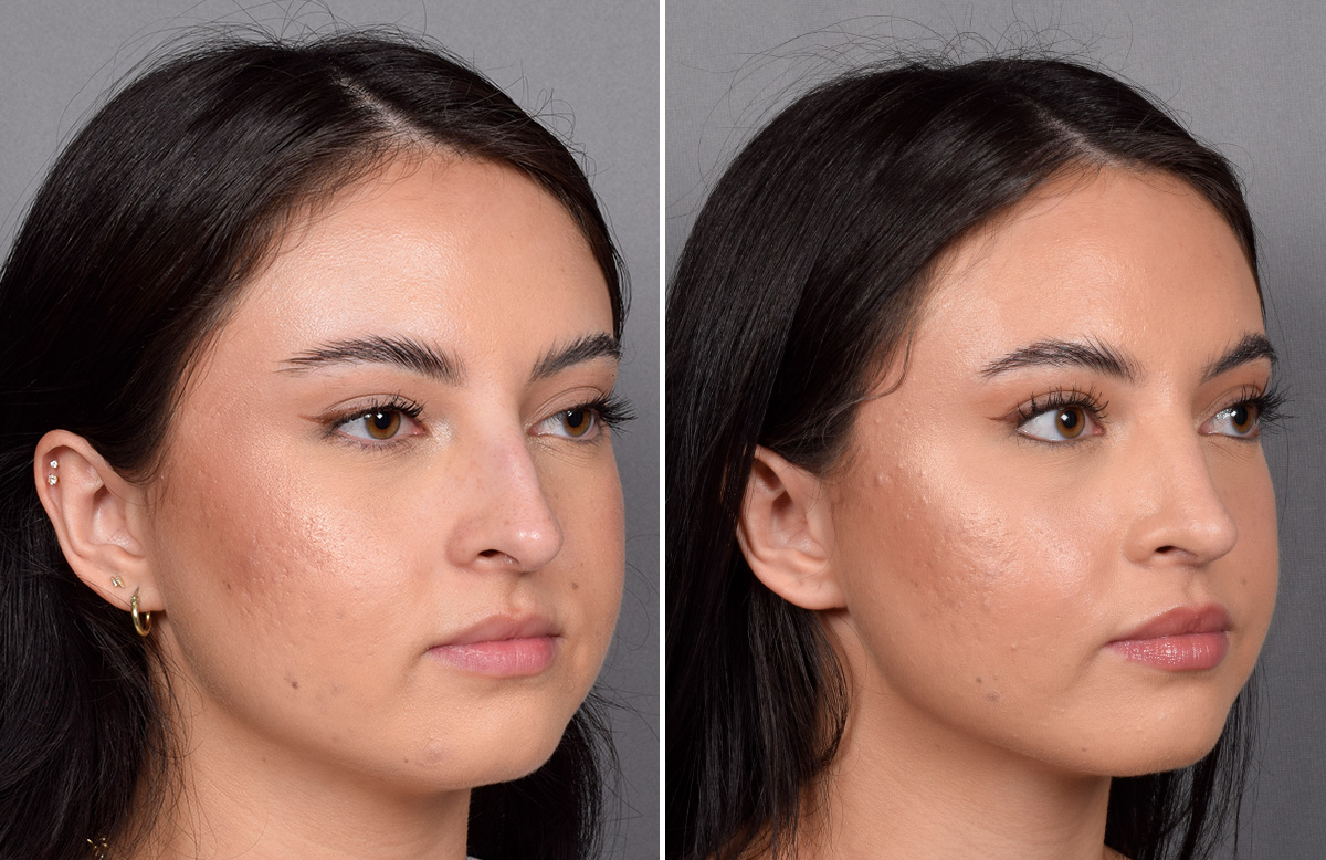 Rhinoplasty Before & After Gallery - Patient 368014 - Image 3