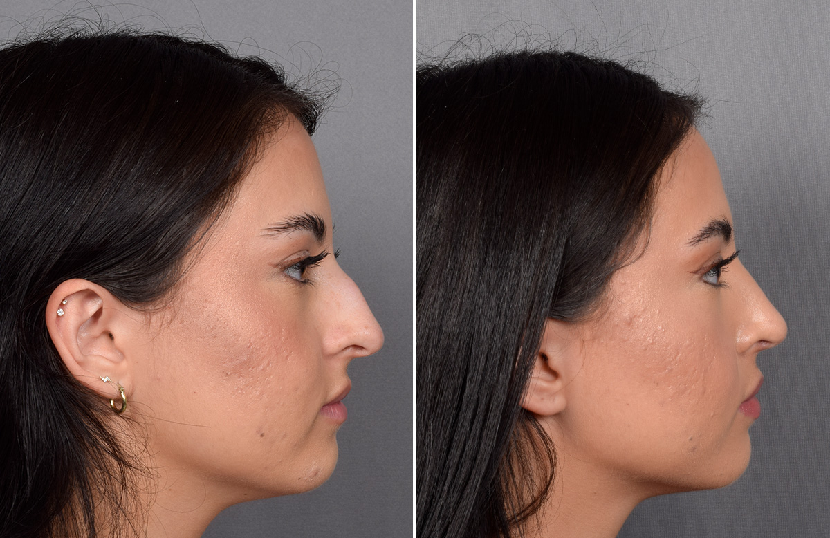 Rhinoplasty Before & After Gallery - Patient 368014 - Image 2
