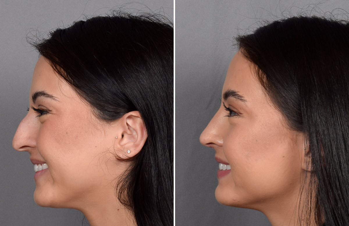 Rhinoplasty Before & After Gallery - Patient 368014 - Image 7
