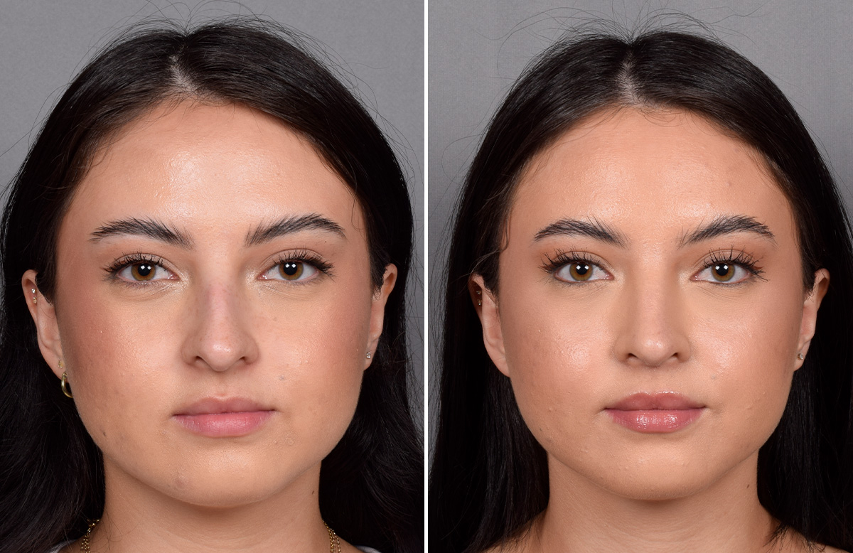 Rhinoplasty Before & After Gallery - Patient 368014 - Image 4