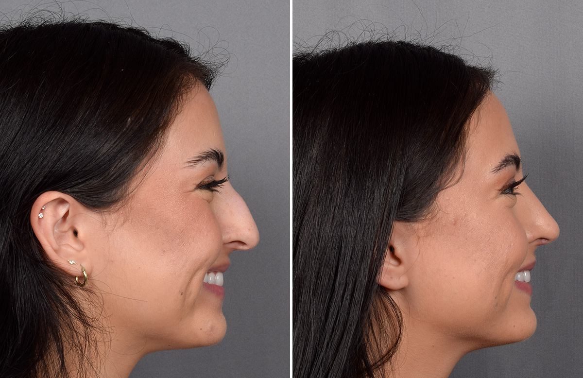 Rhinoplasty Before & After Gallery - Patient 368014 - Image 1