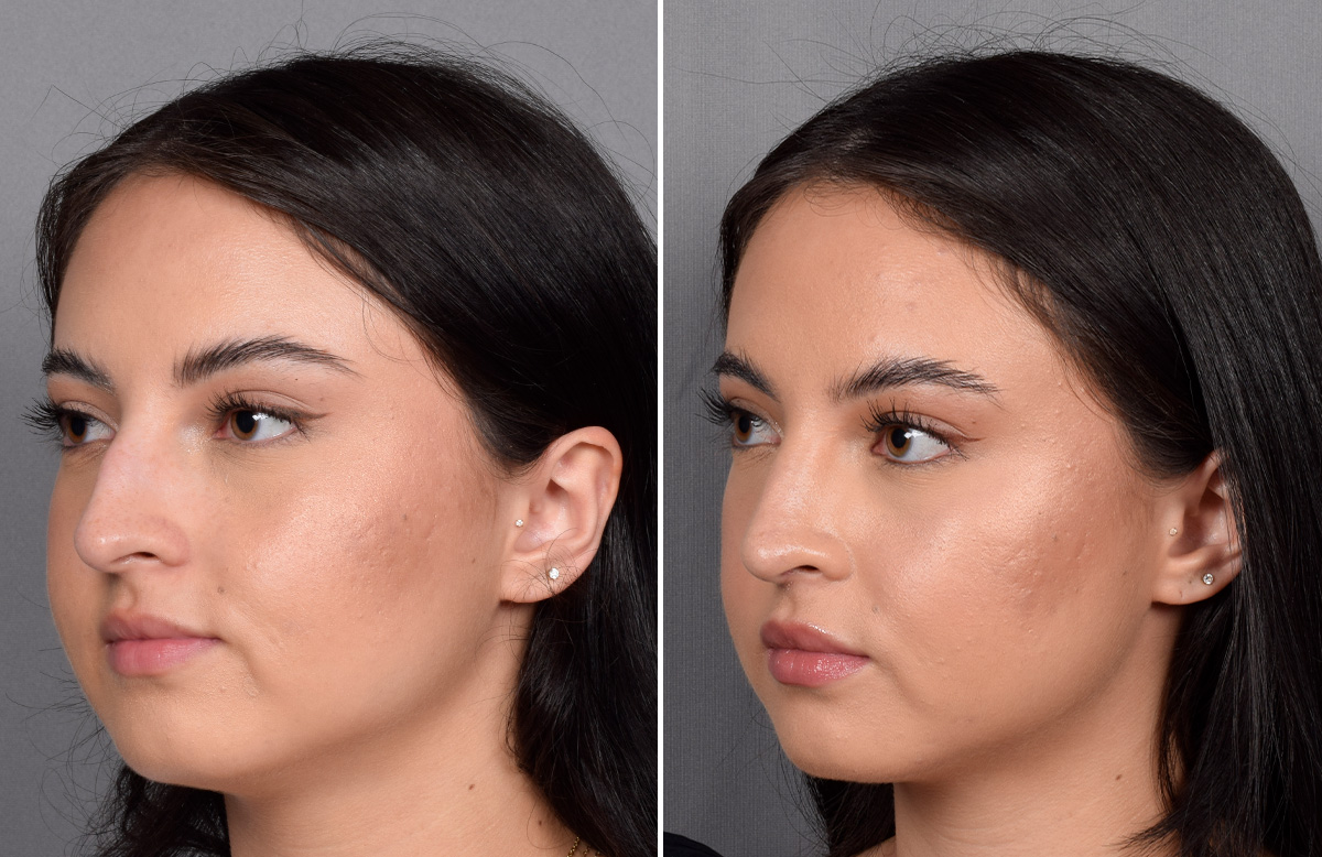 Rhinoplasty Before & After Gallery - Patient 368014 - Image 5