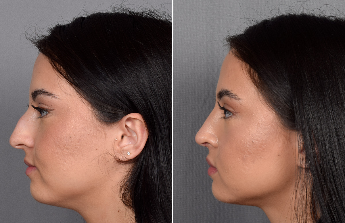 Rhinoplasty Before & After Gallery - Patient 368014 - Image 6