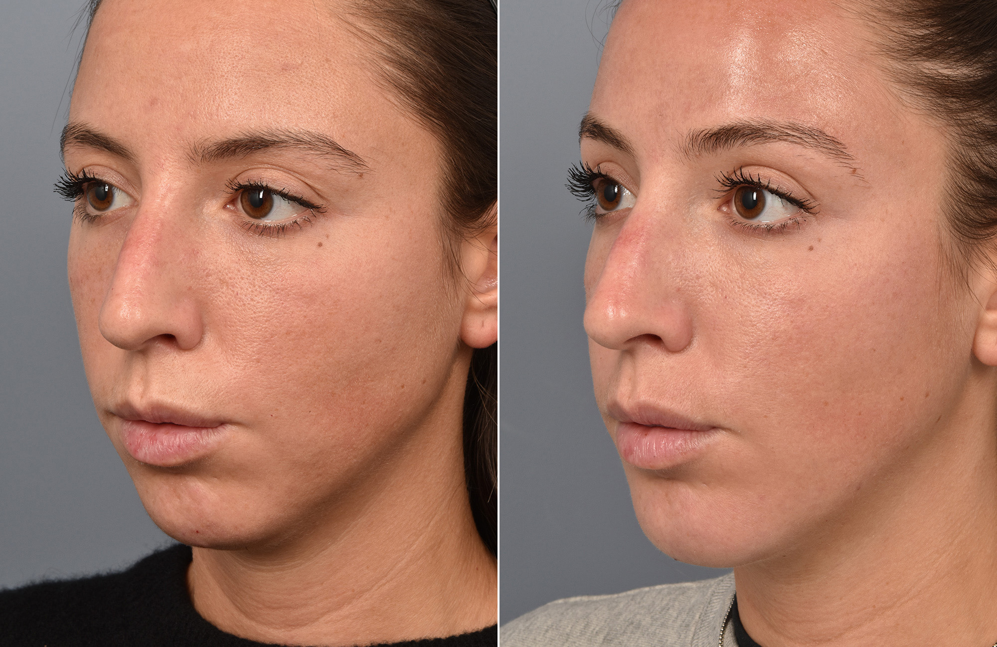 Liposuction Before & After Gallery - Patient 143324 - Image 5